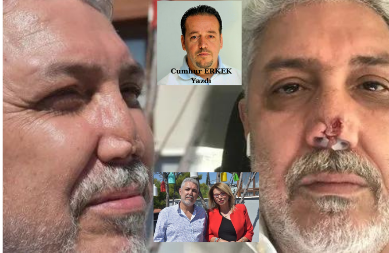 BİLİRKİŞİ HEYETİ DOKTORU KUSURLU BULDU:'İZMİRLİ İŞ İNSANINDAN 5 BUÇUK MİLYONLUK BURUN DAVASI'